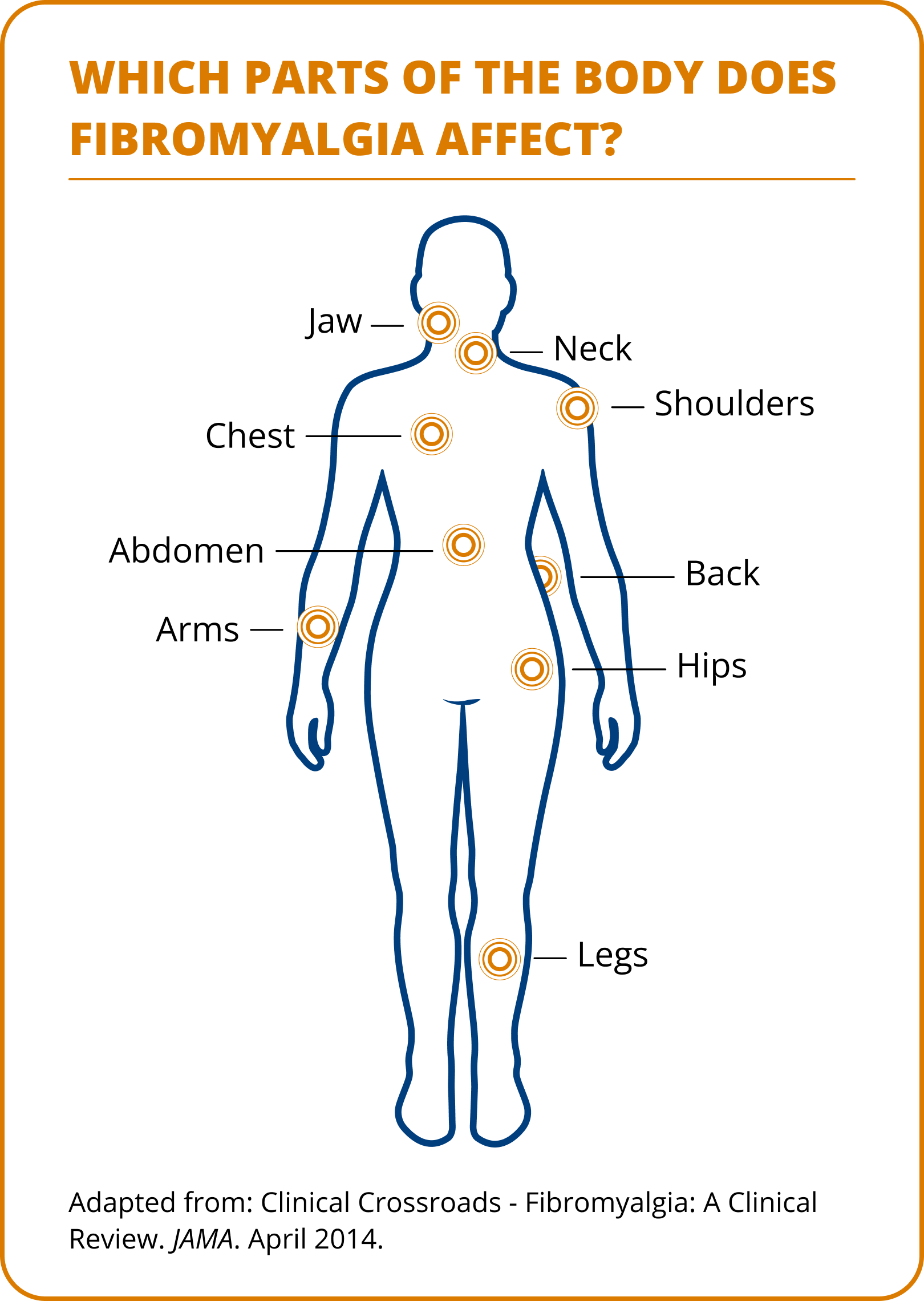 Diagram showing parts of the body affected by fibromyalgia, including the jaw, neck, shoulders, chest, back, arms, abdomen, hips, and legs