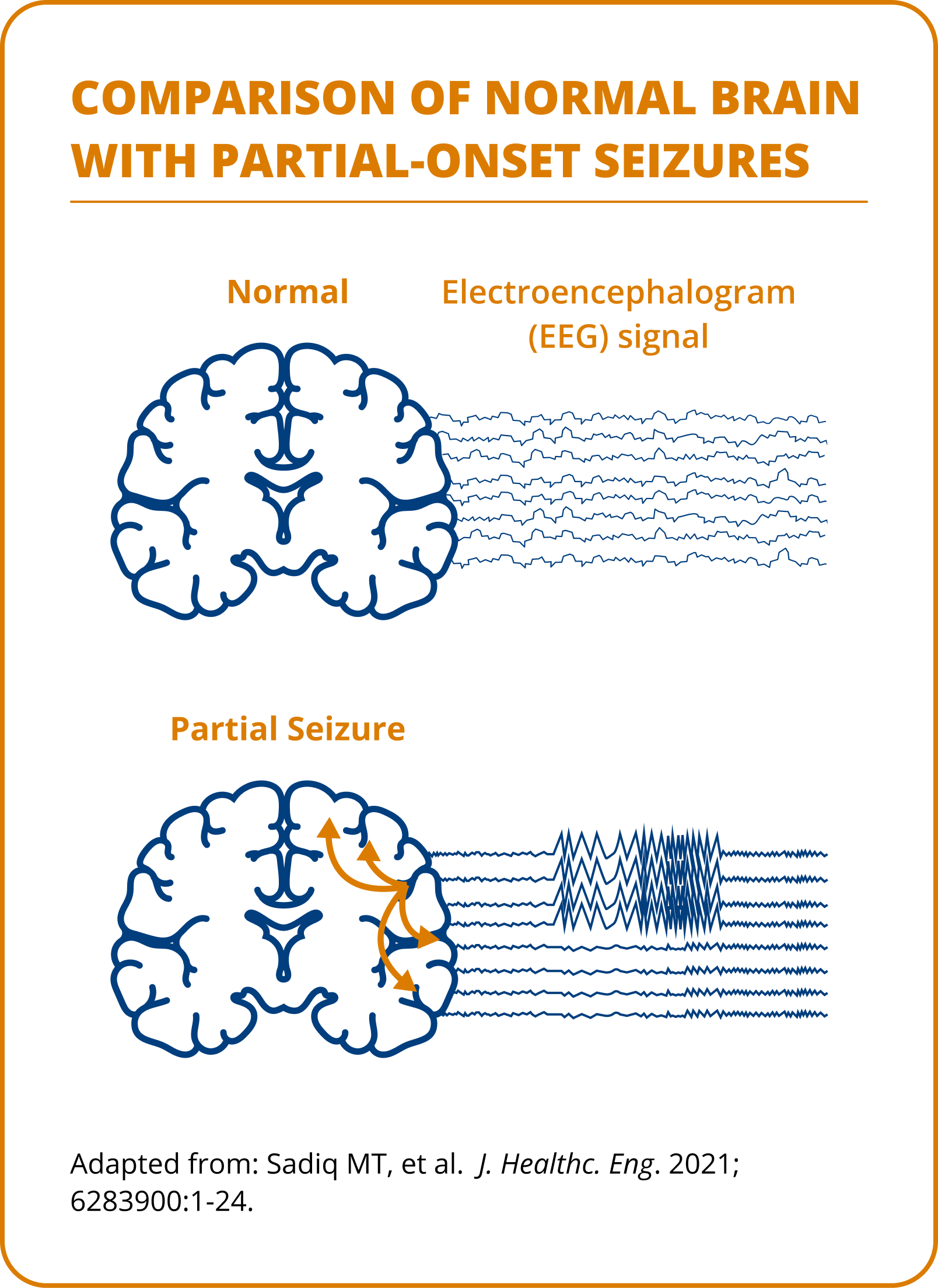 Comparison of normal brain and brain with partial-onset seizures